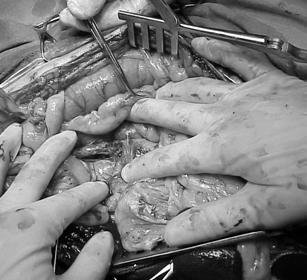 nephro-ureterectomy Ureterotomy