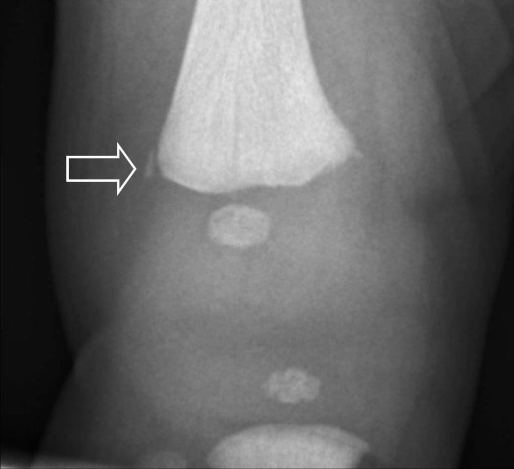 Chapter 8 Figure 2a. Radiograph AP of the right knee show a classic metaphyseal lesion (arrow). Figure 2b. Radiograph lateral of the right knee show a classic metaphyseal lesion (arrow).