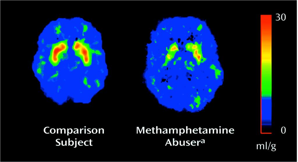 The brain of a drug abuser adapts to counteract the effects of the drug 14 Dopamine transporter levels measured by positron emission tomography