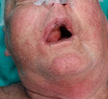 Undifferentiated Sinonasal Carcinoma (SNUC) Case Report 435 Patient medical history states that he was conducted operations polyps in the maxillary sinuses twenty years ago.