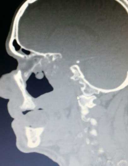 2) showed the presence of infiltrative tumor, the size of 65 mm 40 mm 45 mm in the area of the right maxillary sinus with areas of necrosis.