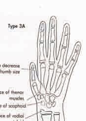 Reconstruction of the existing thumb Index