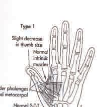 HR, Jr., James M. Type III-A hypoplastic thumb.