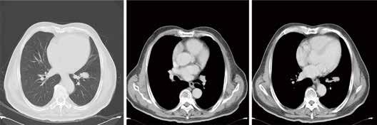 646 Lu and Yang. A nonresponding SCLC combined adenocarcinoma Figure 1 Chest CT scan after two cycles of chemotherapy (October 30, 2015). CT, computed tomography.