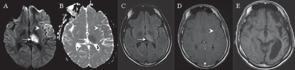 Nwoke et al Figure 1. MRI brain fi ndings on case 1. Arrows indicate signal abnormalities at the thalamus. Arrowheads indicate signal abnormalities at the cortex.