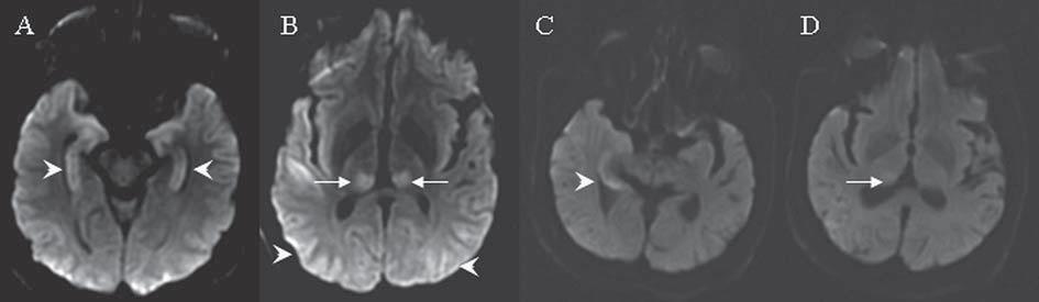 Similar hyperintensities were seen on FLAIR in the left thalamus (C) and left medial temporal lobe (D). Signal changes in the left lenticular nucleus represent an acute hemorrhage (A, C).