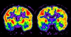 Brain magnetic resonance imaging (MRI), subtracted ictal-interictal SPECT co-registered with MRI (SISCOM) and brain fludeoxyglucose positron emission tomography (FDG-PET) images.