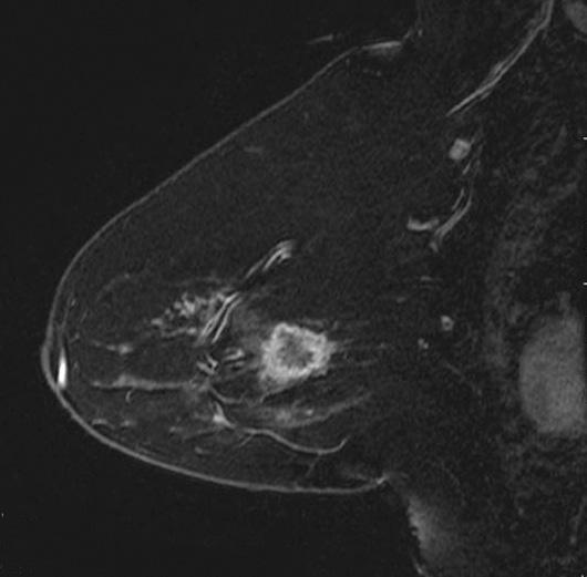 What are the benefits of MRI screening? MRI is able to create very detailed images of the breast tissue.