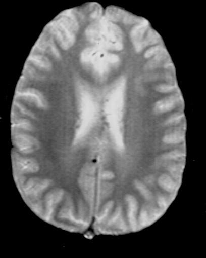 MRI demonstrates petechial