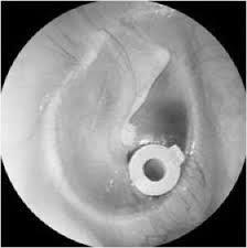 Single Visit Surgery Who: Children with recurrent ear infections Where: Texas