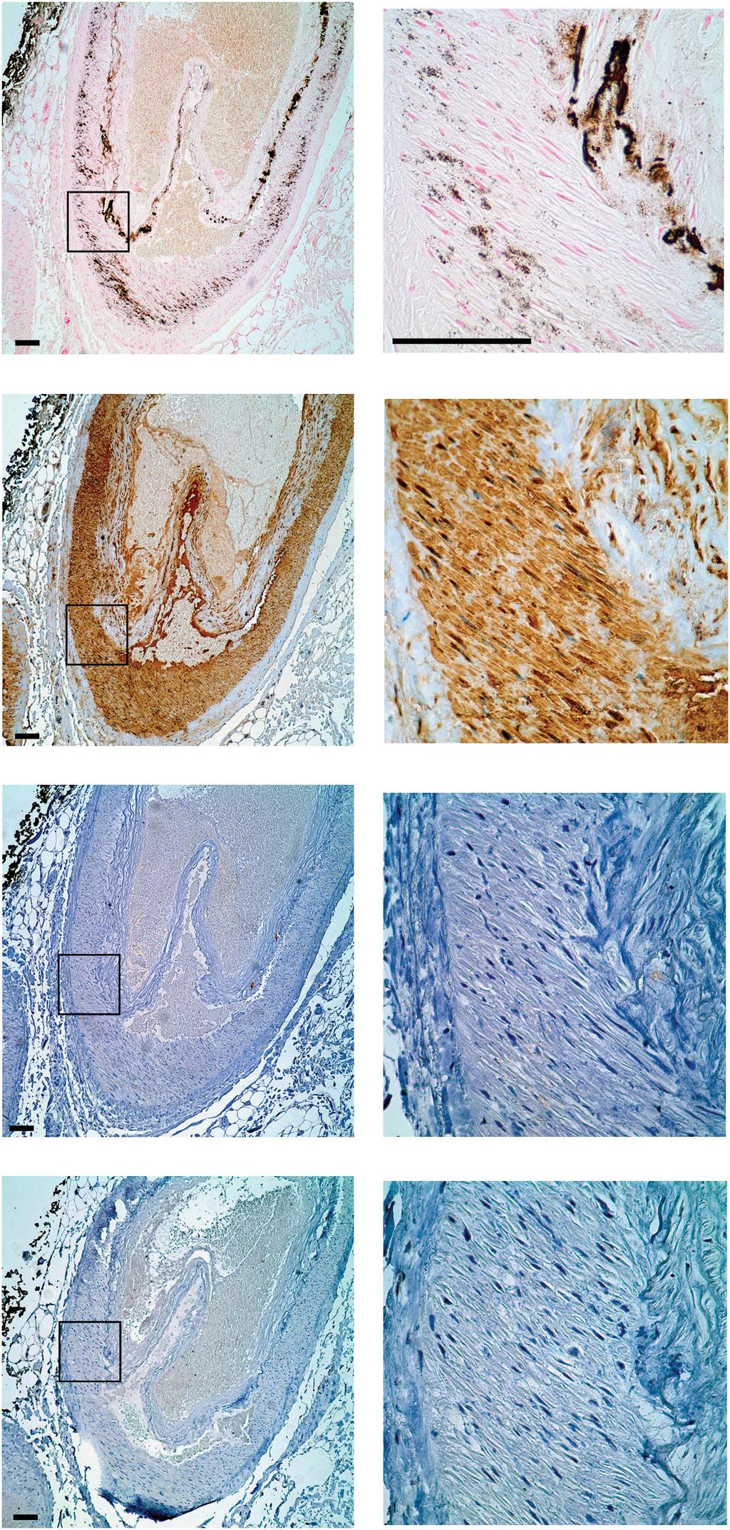 Table 3 Immunohistochemical analysis of calcified breast arteries Specimen Osteocalcin staining Runx2 staining 1 2 3 4 5 6 7 8 9 10 11 12 13 14 15 16 17 18 19 ND ; no VK match Yes ; no VK match ND ;