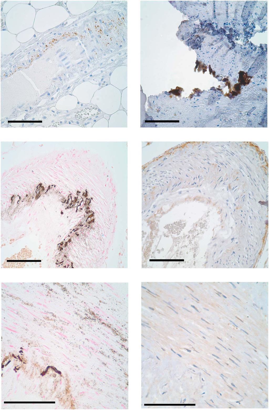 Figure 6 Positive controls for immunohistochemical analysis. (a) Sample of bone showing cellular staining of the osteocytes for osteocalcin. (b) Runx2 staining of placenta.