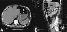 Pancreatic pseudocyst complicated with upper gastrointestinal bleeding 129 Introduction Pancreatic pseudocysts develop in 5% to 15% of cases of acute pancreatitis and in 20% to 40 % of cases of