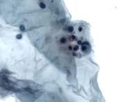 1) Gross examination 2) CEA (best test) 3) Cytology 2) Is the cyst low grade or high