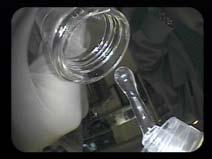 Two basic questions for Cyst analysis Gross Cyst Fluid 1) Is the cyst mucinous or non mucinous?