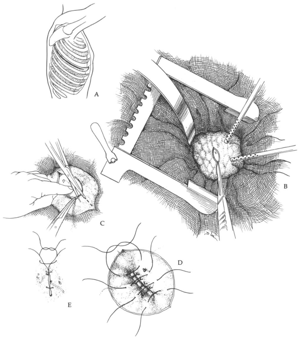 345 Qian: Thoracic Hydatid Cysts Fig 2. Operative technique for intact endocystectomy. (A) Thoracic incision.