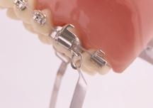 A New Fixed Interarch Device for Class II Correction WILLIAM VOGT, DDS Fixed devices are increasingly being used for molar distalization in Class II treatment because they eliminate the need for