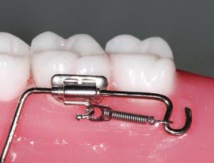 Extension arms are incorporated into both sides of the appliance for connection to the first molars through a pair of.035" light-wire single tubes with hooks.