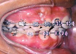 . fter eight months, miniscrews became mobile and palatal bar was impinging on mucosa.