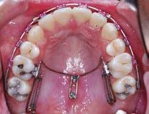 molar distalization.