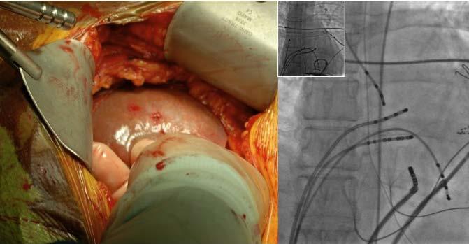Liver Puncture during Epicardial Catheter