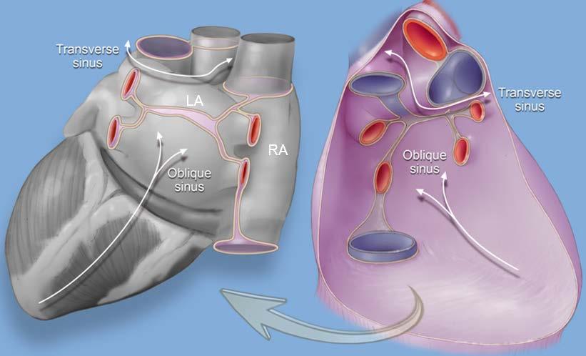 Epicardial VT Ablation: What Can you access?