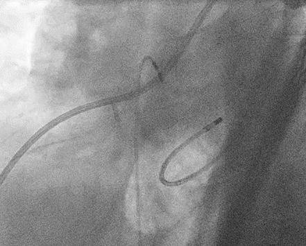 Coronary Angiography Prior to Ablation Away from coronaries: 5 mm