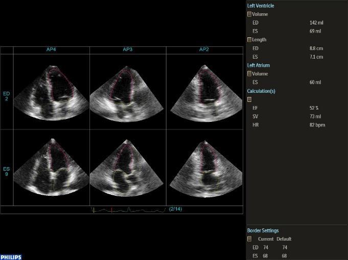 AVA(cm2): (2DCE-HM) 2D CE derived AVA(cm2) 3D full automatic software in the evaluation of aortic stenosis severity in TAVI patients Stroke volume and valvular area analysis are strongly recommended