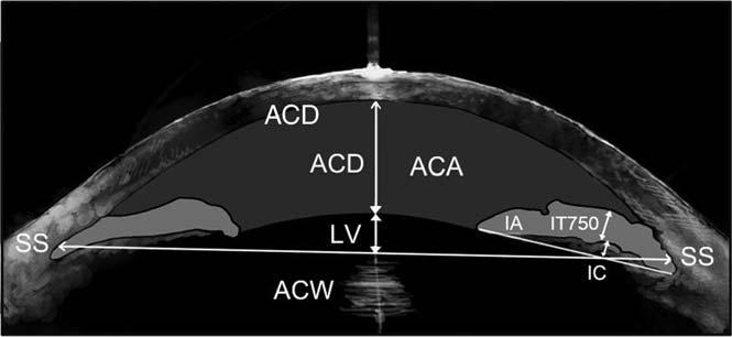 Anterior Segment in Acute Primary Angle Closure IOVS j June 2014 j Vol. 55 j No. 6 j 3647 FIGURE 1. Anterior segment parameters measured by AS OCT and calculated by using ImageJ software.