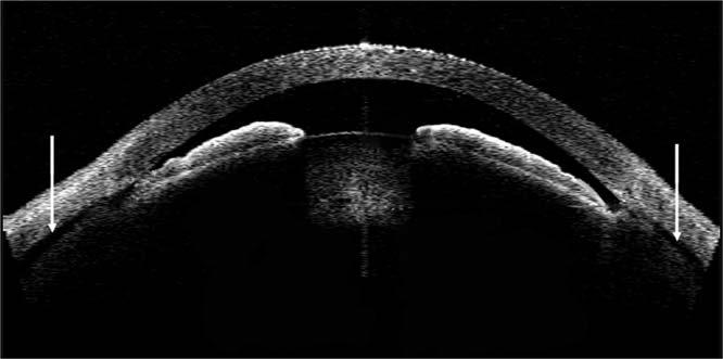 Anterior Segment in Acute Primary Angle Closure IOVS j June 2014 j Vol. 55 j No. 6 j 3650 FIGURE 3. AS OCT images of an eye with APAC. Uveal effusion was observed on both the nasal and temporal sides.