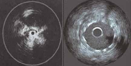 Figure 3. IVUS before () and after () stenting. Figure 4. Extensive acute on chronic thrombosis before () and after () PMT and iliocaval stenting.