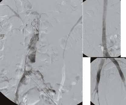 Venous outflow obstruction can be identified using standard transfemoral venography by finding a definite obstruction or the development of transpelvic collaterals.
