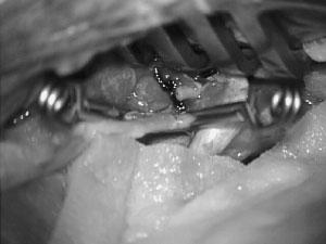 The arteriotomy is extended using a microscissor to the width of the donor vessel lumen. The lumen of the donor vessel is expanded by fish-mouthing the opening.