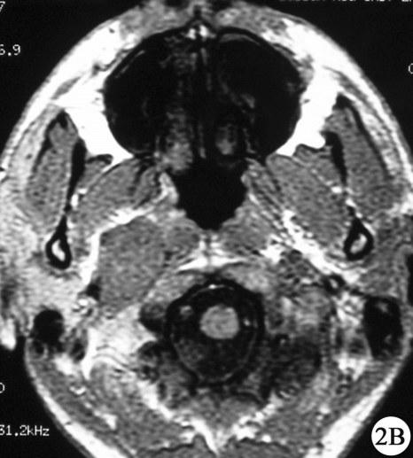 B, Coronal T1-weighted gadolinium-enhanced MRI showing a parapharyngeal space lesion extending to lateral skull base. C, D, Postoperative axial T2-weighted MR and coronal MR (TR/TE=4.3/2.