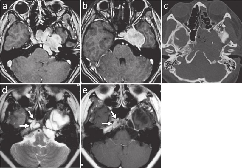 LONG - TERM OUTCOME OF CLIVAL CHORDOMAS 7 Fig. 5. Case 2. a, b : Preoperative enhanced axial MRI showing a clival tumor extending to the left cavernous sinus and petrous bone.