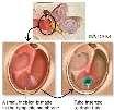 Ear Infections (middle ear) Other Disorders of the Auditory System Middle ear infections are a fluid build-up behind the eardrum.