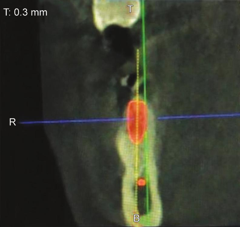 JCDP Reliability of OPG and CBCT in Presurgical Implant Planning A B Figs 3A and B: Assessment of available bone height and bone width on CBCT Fig.
