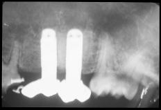 Fig 2 Radiographic view of the control model taken just before sacrifice. No occlusal stress was added; no notable changes were observed.