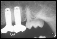 12 Fig 4 Radiographic view of model with supraocclusion produced by excess height of 180 µm. Bone resorption was seen at the mesiodistal of the marginal bone level on both implants.