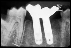 More bone resorption was seen than in the 180-µm model at the mesiodistal of the marginal bone level and in the apical direction on both implants.