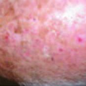 It is also important to look out for pre-cancerous skin lesions such as Actinic