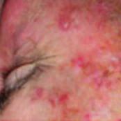 Keratosis, AK, SK) are pre-cancerous skin lesions with the potential to develop into