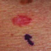 Carcinomas (BCC s or Rodent Ulcers) are the most common type of Skin Cancer, accounting