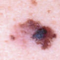 Malignant Melanoma Malignant melanoma is the rarest form of skin cancer, but is the most serious and can kill.