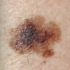 Malignant melanoma has the potential to spread to other sites and organs within the body, making early detection of the disease vital for survival.