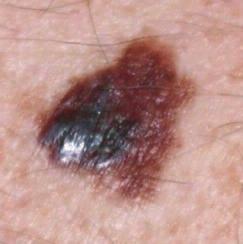 Early Detection A = ASYMMETRY When half the mole does not match the other half B = BORDER When the borders of the mole are irregular/ragged Those most at risk from melanoma are those with fair skin,