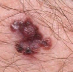 A melanoma can grow anywhere on the body so it is important to check your entire body regularly (once per month) for any changes or abnormalities.