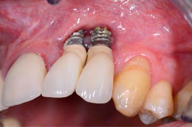 extended edentulous spaces