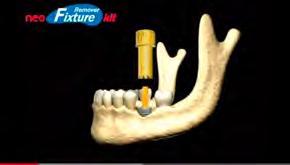 Technique Implant removal must be done as carefully as possible Rule #1: Don t touch the palatal bone wall Trephines, recommended in the 1990 s, are completely out today - They are causing too much