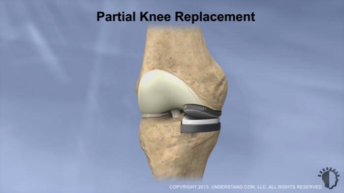 Introduction A partial knee replacement removes damaged cartilage from the knee and replaces it with prosthetic implants.